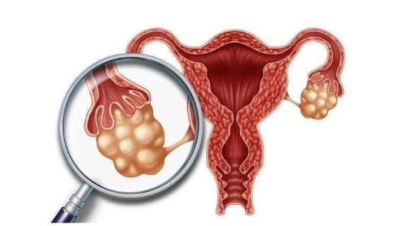 子宫内膜异位症为什么难怀孕