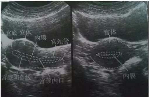 【成都市生殖健康研究中心】教你读懂妇科B超检查结果